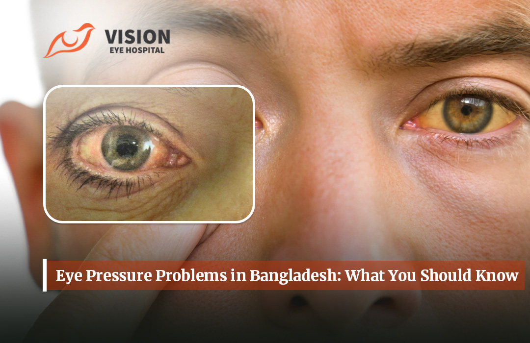 Eye Pressure Problems in Bangladesh: What You Should Know