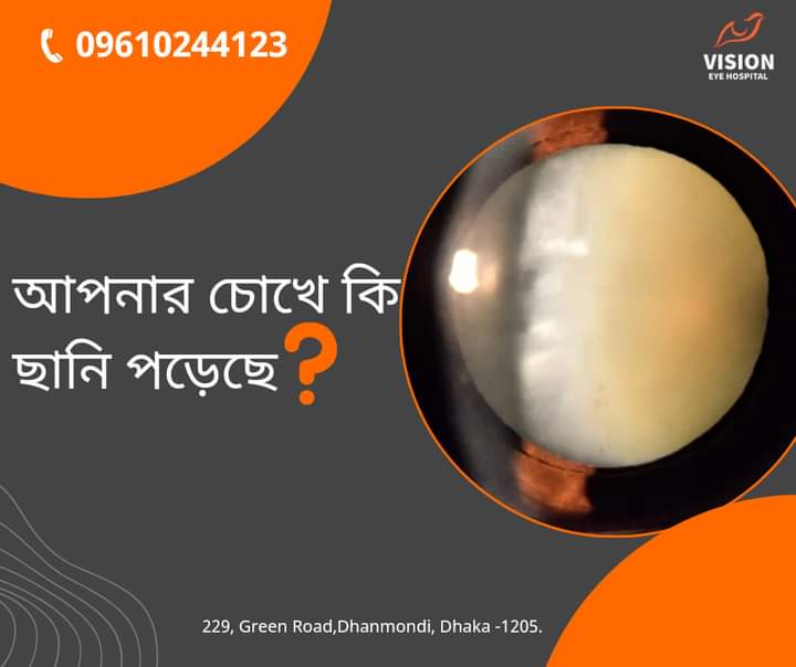 আপনার চোখে কি ছানি পড়েছে?