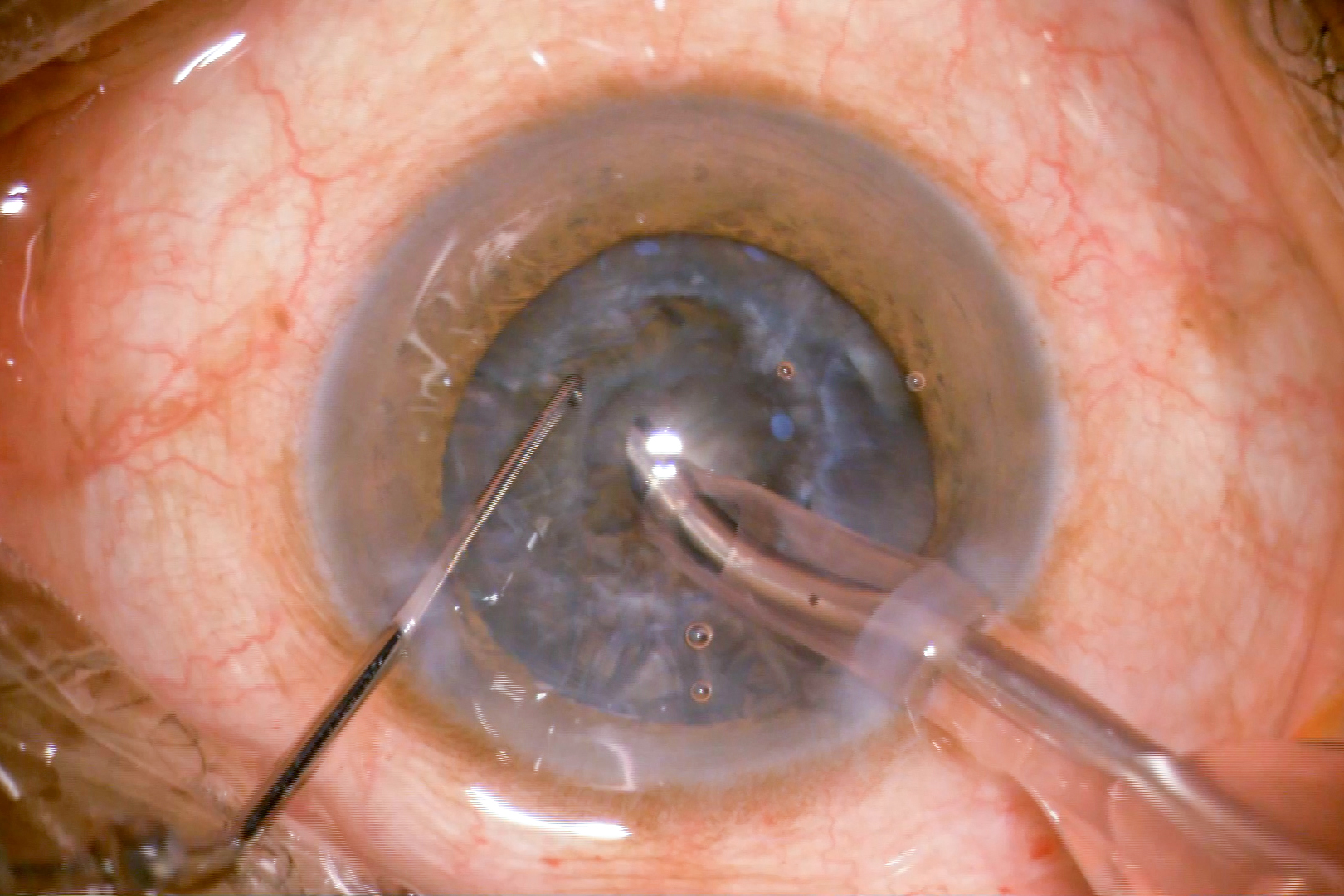 Cataract Surgery| All About Cataract Surgery In Bangladesh