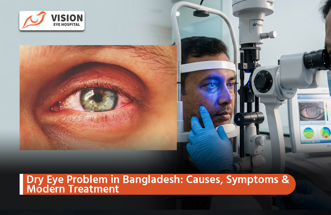 Dry Eye Problem in Bangladesh: Causes, Symptoms & Modern Treatment