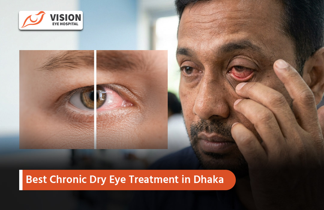 Best Chronic Dry Eye Treatment in Dhaka
